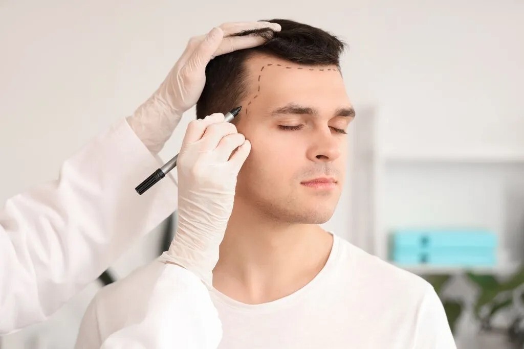 Hair transplant treatment in Islamabad (2)