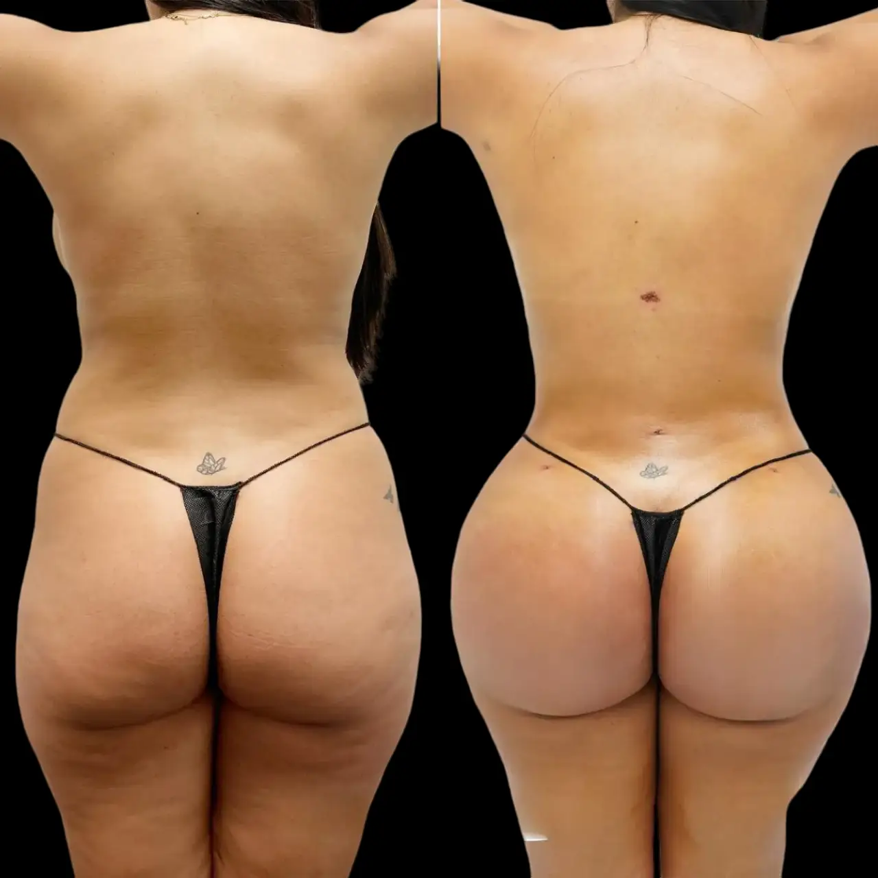 Best Butt Fat Transfer in Dubai