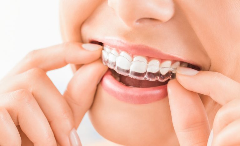 Invisalign Braces Dubai