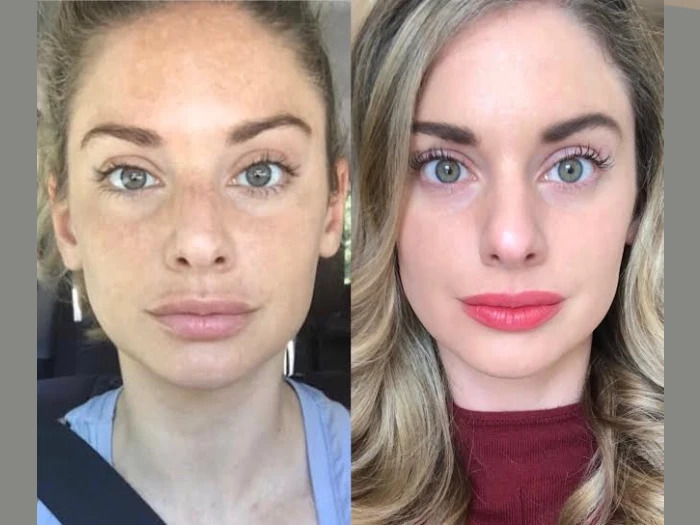 Radiofrequency (RF) Microneedling treatments in Dubai