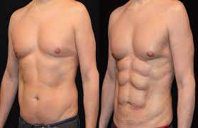 Male Liposuction in Dubai
