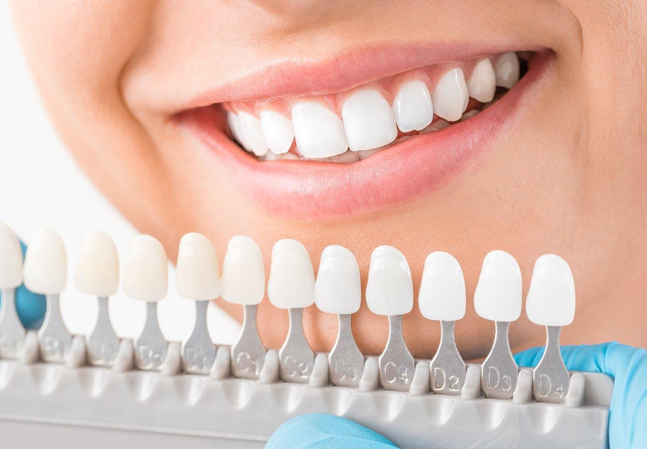 Veneers in Dubai