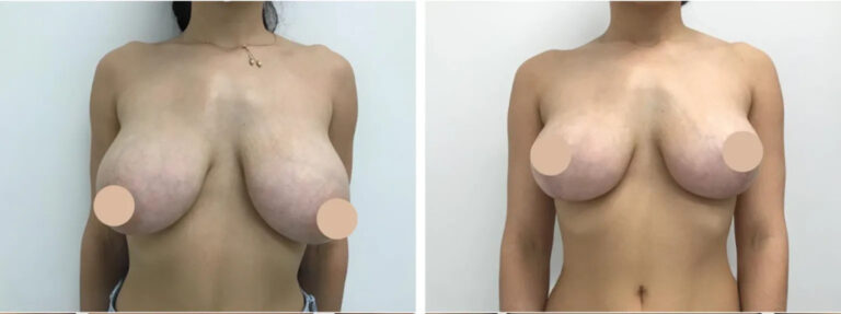 Experience Premium Breast Lift in Dubai