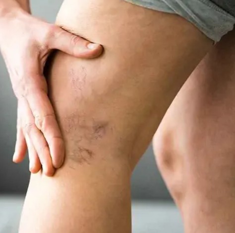 Varicose-Veins-Treatment-In-Dubai