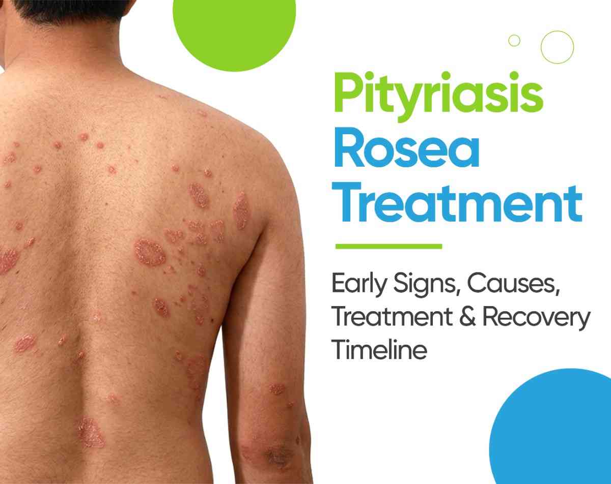 pityriasis rosea
