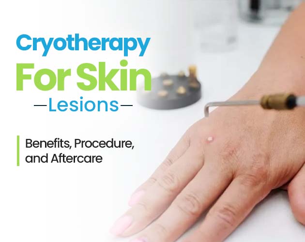 cryotherapy