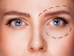Chirurgie des paupières supérieures à Paris
