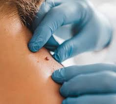 Moles Removal in Dubai