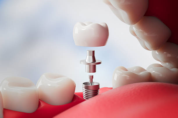 Dental Implants Simi Valley