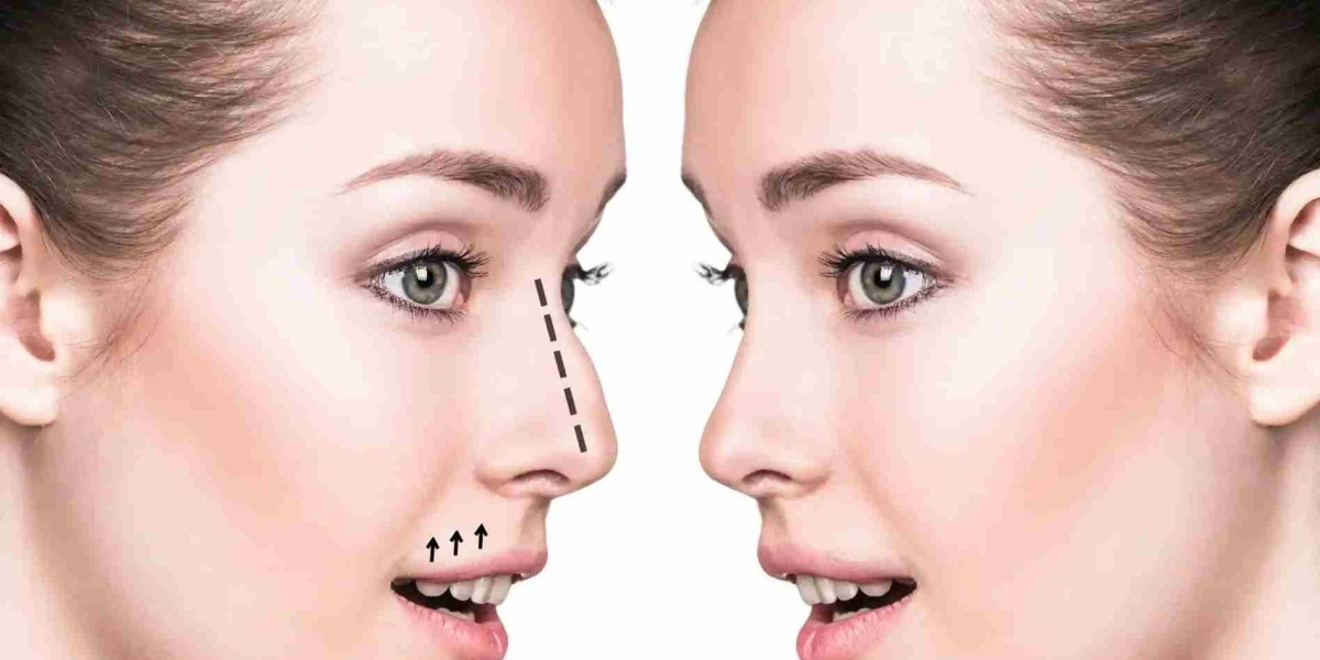 rhinoplasty in dubai