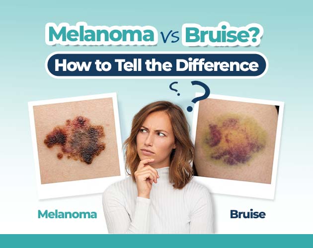 melanoma